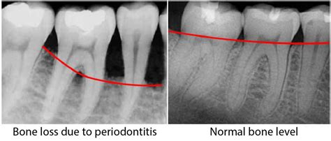 Periodontal Disease Radiographs