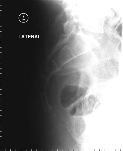 Post Gad: Sacral Fracture