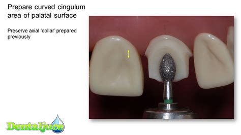 Incisor MC (PFM) Prep | Enhanced Dental CPD Online