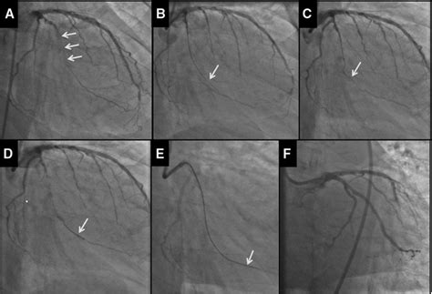 Subintimal Dissection Reentry Strategies In Coronary Chronic Total