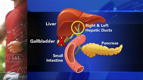 What Are Gallstones Gallbladder Attack Symptoms Diagnosis And