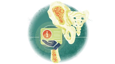 New Insights Into The Complex Biology Of Osteoporosis MedPage Today