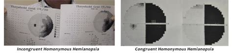 Visual Fields in Brain Injury - Hemianopsia.net Everything you need to ...