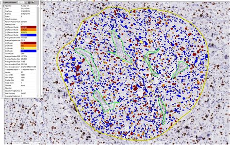 Assessment Of Ki67 Labeling Index In Adrenal Cortical Carcinomas The Download Scientific