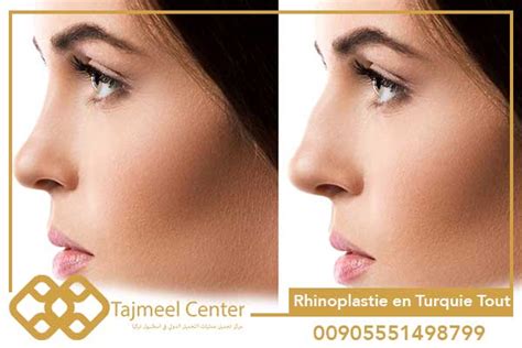 Rhinoplastie En Turquie Tout Compris Votre Guide Complet