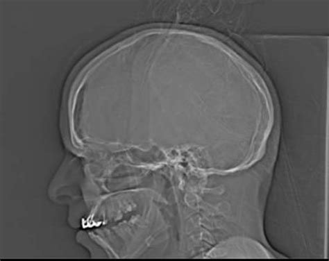 Unilateral pneumocephalus (CT scan, axial section, brain window). | Download Scientific Diagram