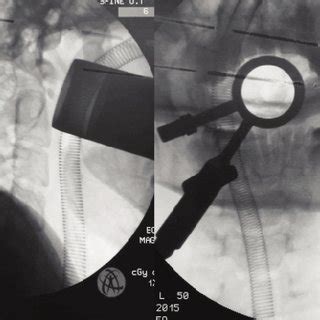 CT scan showing dystrophic form of os odontoideum. MRI showing the... | Download Scientific Diagram