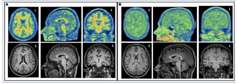 Decreased Graywhite Matter Contrast Of C Pib Uptake In Cognitively