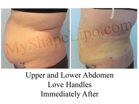 Abdominal Liposuction Vs Tummy Tuck Surgery Liposuction Tummy Tuck