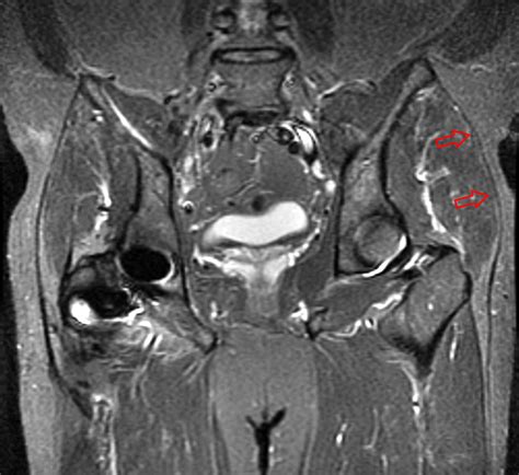 Iliotibial Band Syndrome Ultrasound