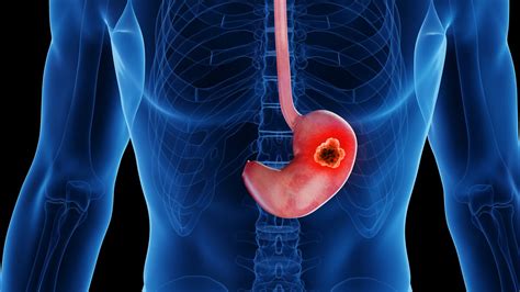 Stomach cancer: a new treatment discovered – Archyde