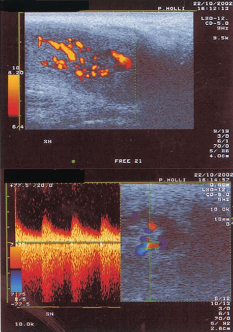 Color Doppler Ultrasound Scan Showing Turbulent High Speed Flow Along