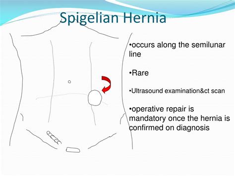 Ppt Hernia Powerpoint Presentation Free Download Id2957512