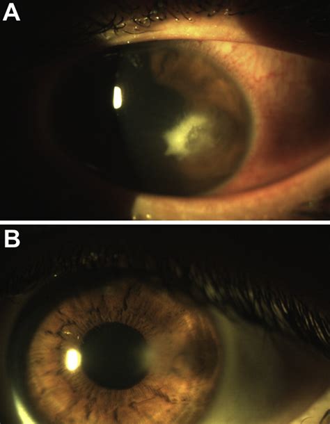 Complementary Treatment Of Contact Lens Induced Corneal Ulcer Using