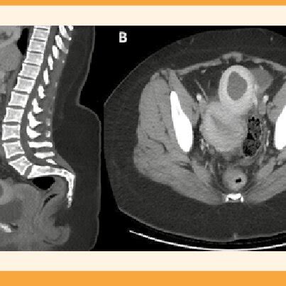 Tomografía abdominal A corte sagital y B transversal Hemiútero