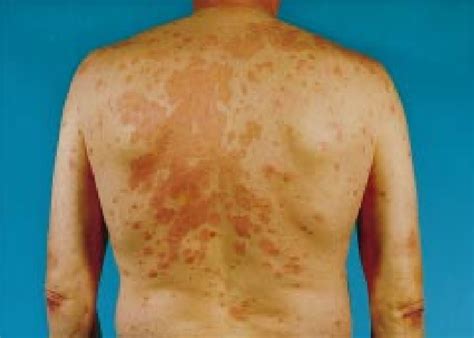 Figure 2 From Paraneoplastic Skin Manifestations Of Lung Cancer