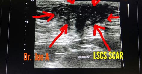 Ultrasound imaging: LSCS scar endometriosis