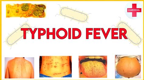 Typhoidenteric Feverpathogenesis Symptoms Diagnosis And Treatment