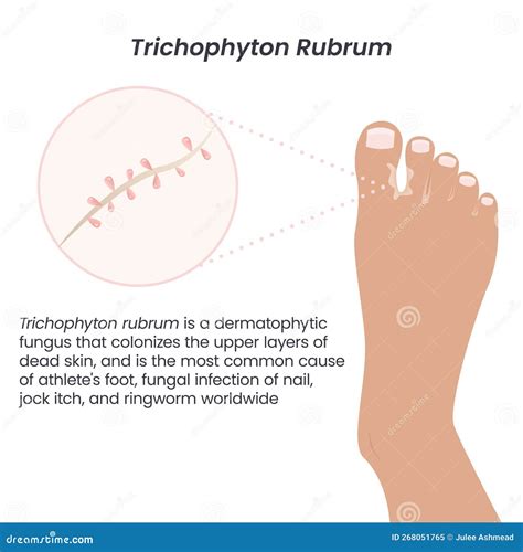 Trichophyton Rubrum Fungus Vector Illustration Graphic Stock Vector - Illustration of toenail ...