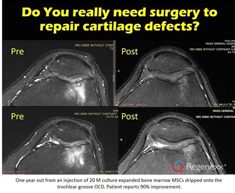 What S Possible With Stem Cells Cartilage Regrowth Regenexx Blog