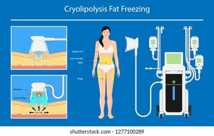 Cryolipolysis Fat Freezing Procedure Cold Treatment Stock Vector