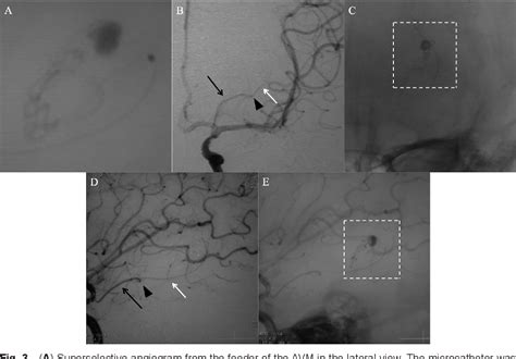 Figure From Intraventricular Hemorrhage Due To A Distal Anterior