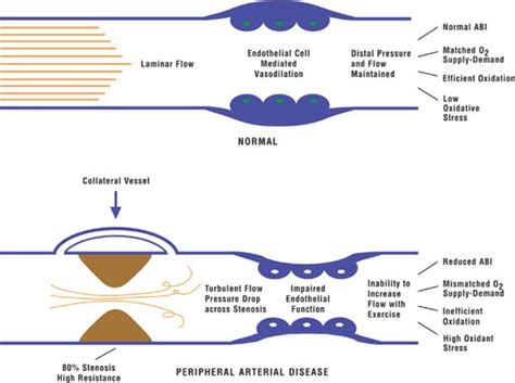 claudication physiopedia