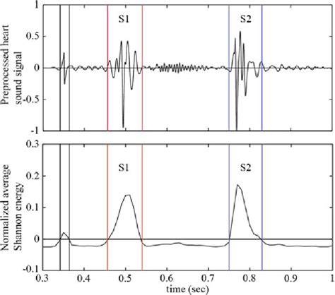 Figure 1 from Automated Identification of Innocent Still's Murmur in Children | Semantic Scholar