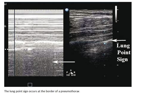 Ultrasonographic Features Of Pneumothorax Deranged Physiology