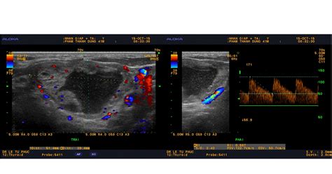 VIETNAMESE MEDIC ULTRASOUND: CASE 341: THYROID TOXIC ADENOMA, Dr LÊ TỰ ...