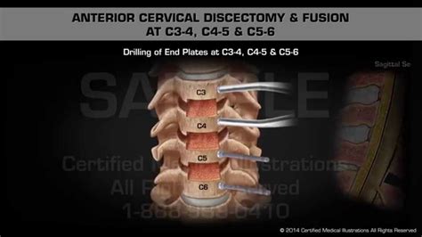 Anterior Cervical Discectomy And Fusion At C3 4 C4 5 And C5 6 Youtube