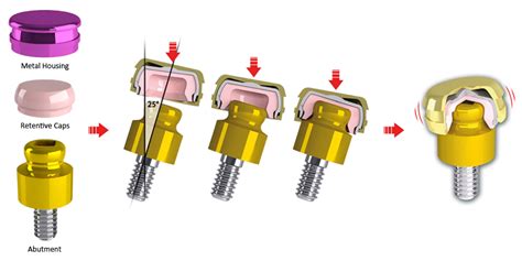 Ot Equator® Titanium Abutment For Straumann Bone Level Rc Implant φ4