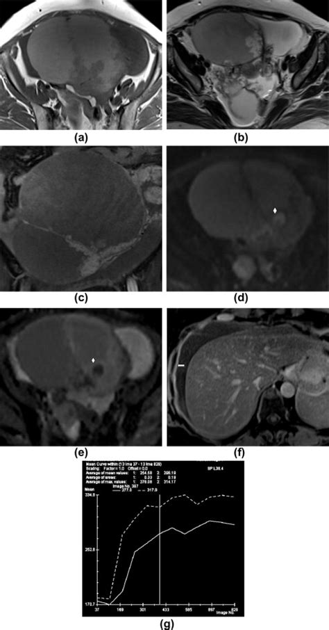 55year Old Patient With Bilateral Mucinous Cystadenocarcinoma A