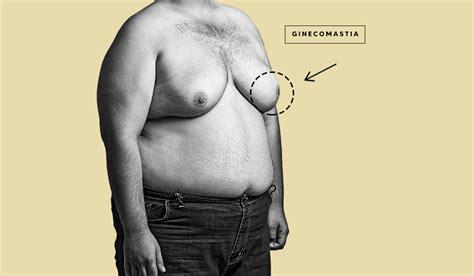 Ginecomastia Cirurgia de Redução de Mama Masculina Dr Etienne Soares