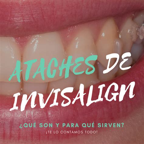 Ataches Ortodoncia Invisalign Madrid