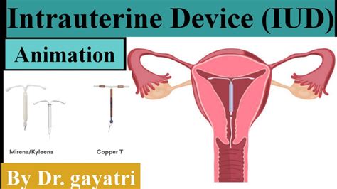 Intrauterine Device Iud Copper T Insertion And Removal Animation Mirena Youtube