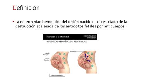 Enfermedad HemolÍtica Del ReciÉn Nacido Pptx Descarga Gratuita