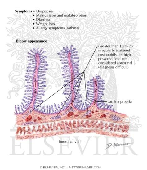 Eosinophilic Gastroenteritis