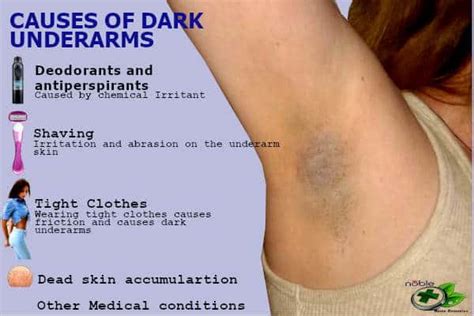 Causes And Treatments For Hyperpigmentation Under The Arms Justinboey