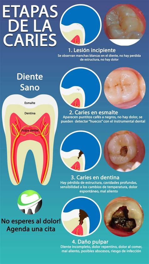 Todo Lo Que Debes Saber Sobre La Caries Dental Clinica Abarno