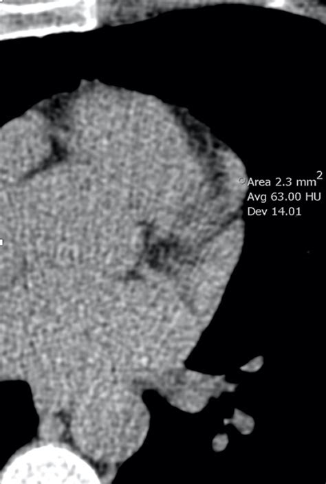 Role Of Coronary Ct Angiography In Spontaneous Coronary Artery