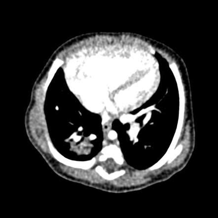 Pulmonary Sequestration Extralobar Radiology Reference Article