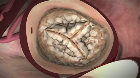 Aortic Valve Replacement Open Heart Surgery Heart Care Anatomy