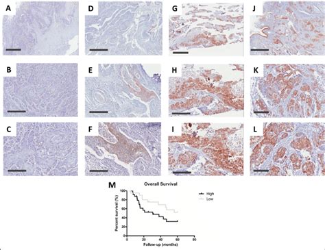 Alcam Protein Levels In Lscc And Its Association To Prognosis