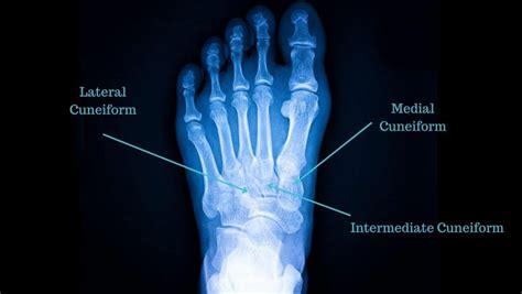 Cuneiform Fracture: Symptoms and Treatment Explained