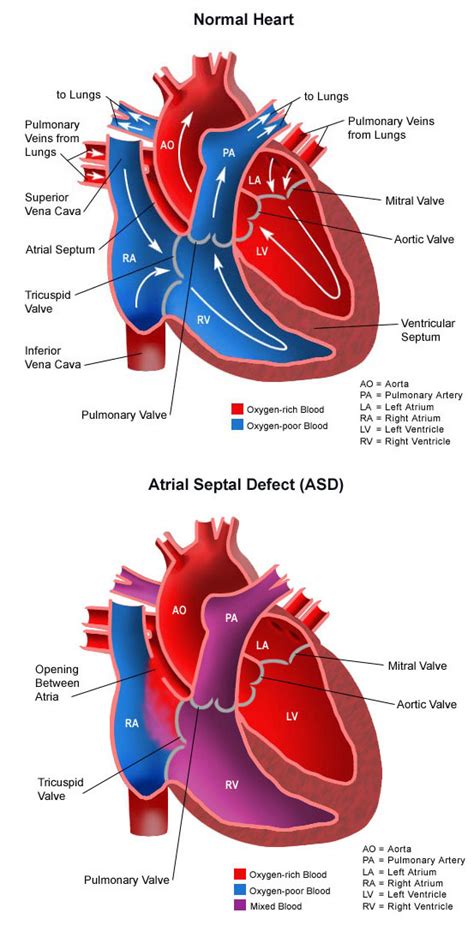 Atrial Septal Defect Symptoms In Infants