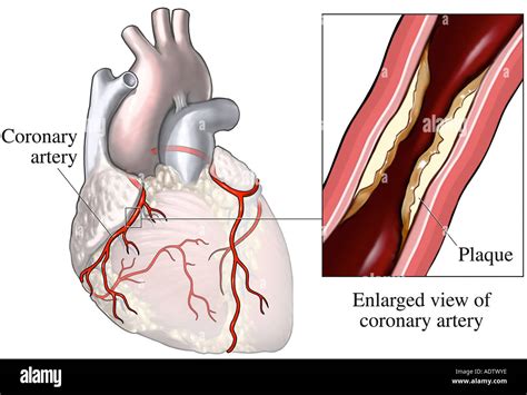 Enfermedad arterial coronaria fotografías e imágenes de alta resolución