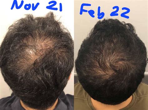 Minoxidil 5 Twice A Day Prrp Every Two Weeks 6 Times Including