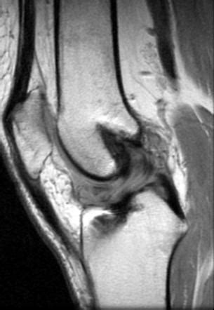 Cyclops Lesion Image Radiopaedia Org