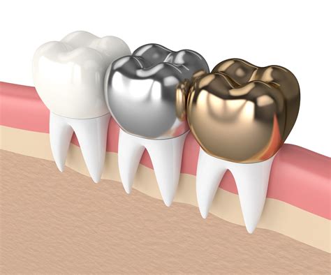 Silver Tooth Crowns Benefits Treatment And Side Effects